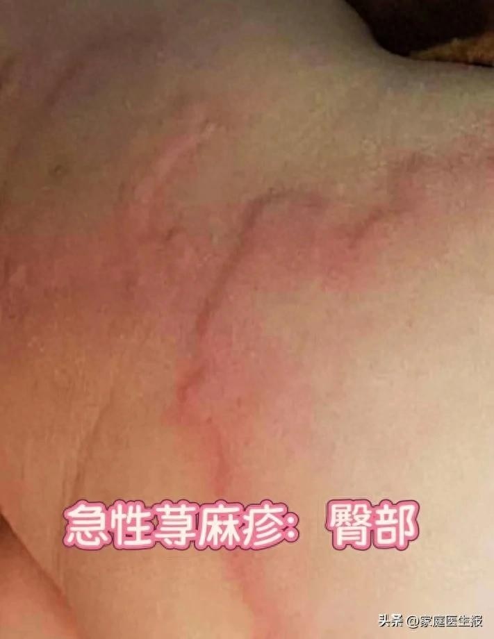 儿童常见皮疹分辨与治疗指南，必备知识，建议收藏！